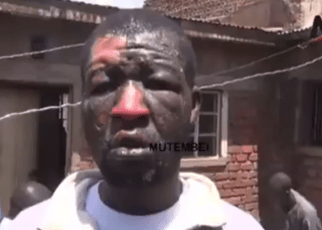 DRAMA-Migori man badly burnt by wife after argument over bedroom matters (VIDEO)
