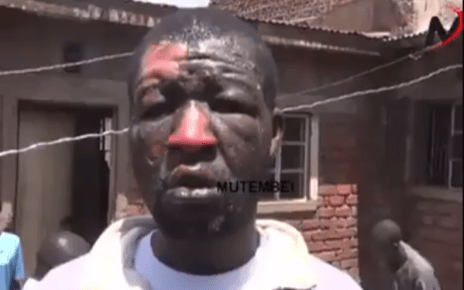 DRAMA-Migori man badly burnt by wife after argument over bedroom matters (VIDEO)